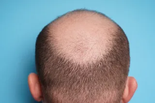 Hair loss pipeline looking thicker as investors plough $270 million into a cure for balding